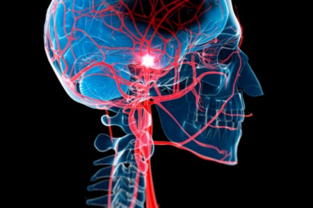 Nerves When Brain Stroke Happens - Brevard Health Alliance